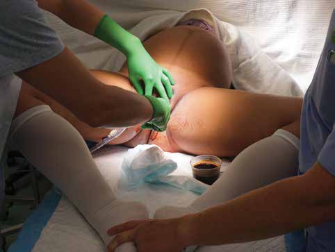 Layers cut during a caesarean (c-section)