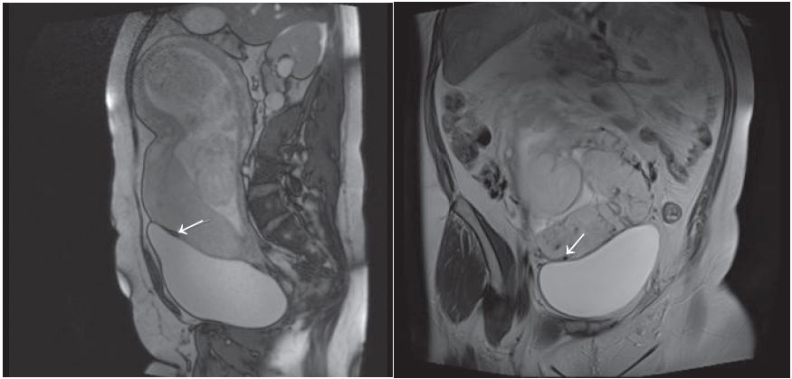 (Left) Sagital True FISP image showing placenta accreta at bladder/ placental interface (arrow). (Right) Coronal blade image showing placenta accreta at bladder placental interface.
