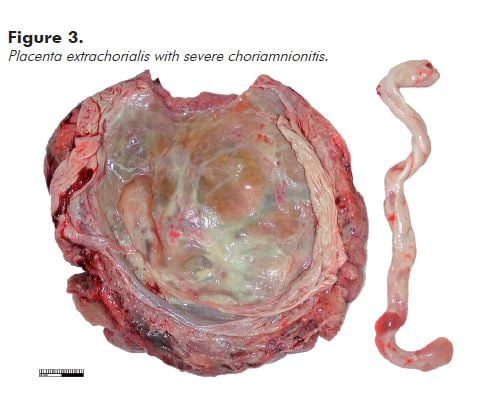 Figure 3. Placenta extrachorialis with severe choriamnionitis.