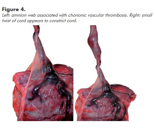 Figure 4. Left: amnion web associated with chorionic vascular thrombosis. Right: small twist of cord appears to constrict cord.