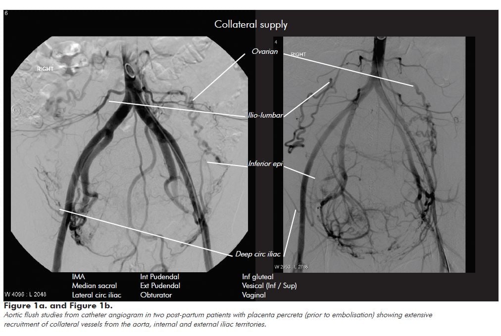Figure 1a. and Figure 1b. Aortic flush studies from catheter angiogram in two post-partum patients with placenta percreta (prior to embolisation) showing extensive recruitment of collateral vessels from the aorta, internal and external iliac territories.
