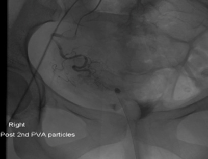 Angiography: Post R) uterine artery embolisation. 