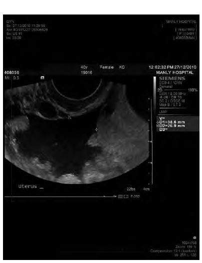 Adjacent free fluid was present in this case of ovarian torsion.