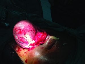 Right tubo-ovarian abscess.
