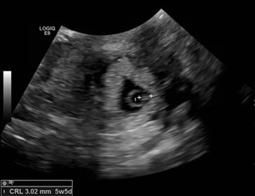 Figure 3. Left ectopic pregnancy, CRL 3.02 mm. 
