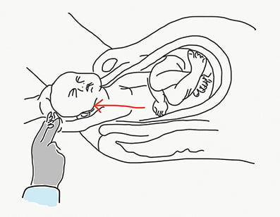Figure 2. Delivery of posterior arm.