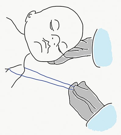 Figure 3. Posterior axillary sling traction.
