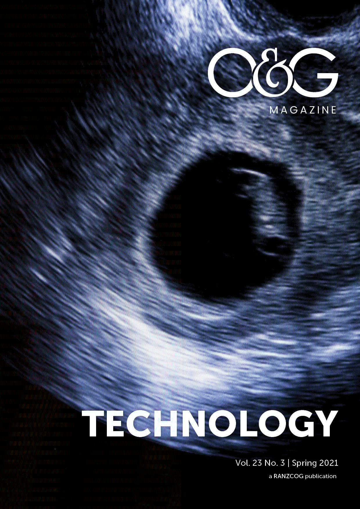 Endometrial Ablation Weight Gain 80 - jrbtqti