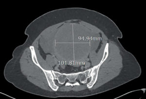 intraperitoneal haemorrhage on CT