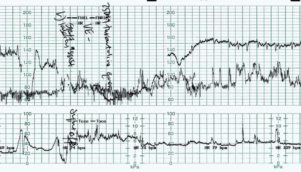 Fetal bradycardia