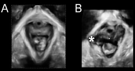 Pelvic floor trauma visible on ultrasound