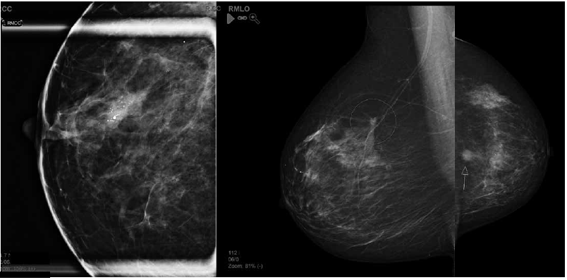 mammogram examples