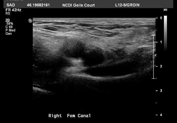 inguinal canal