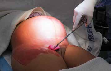 Caesarean section skin preparation