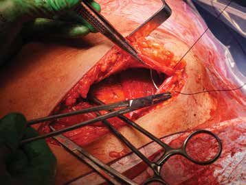 Caesarean section: step by step - O&G Magazine