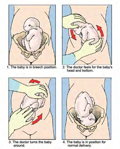 external cephalic version