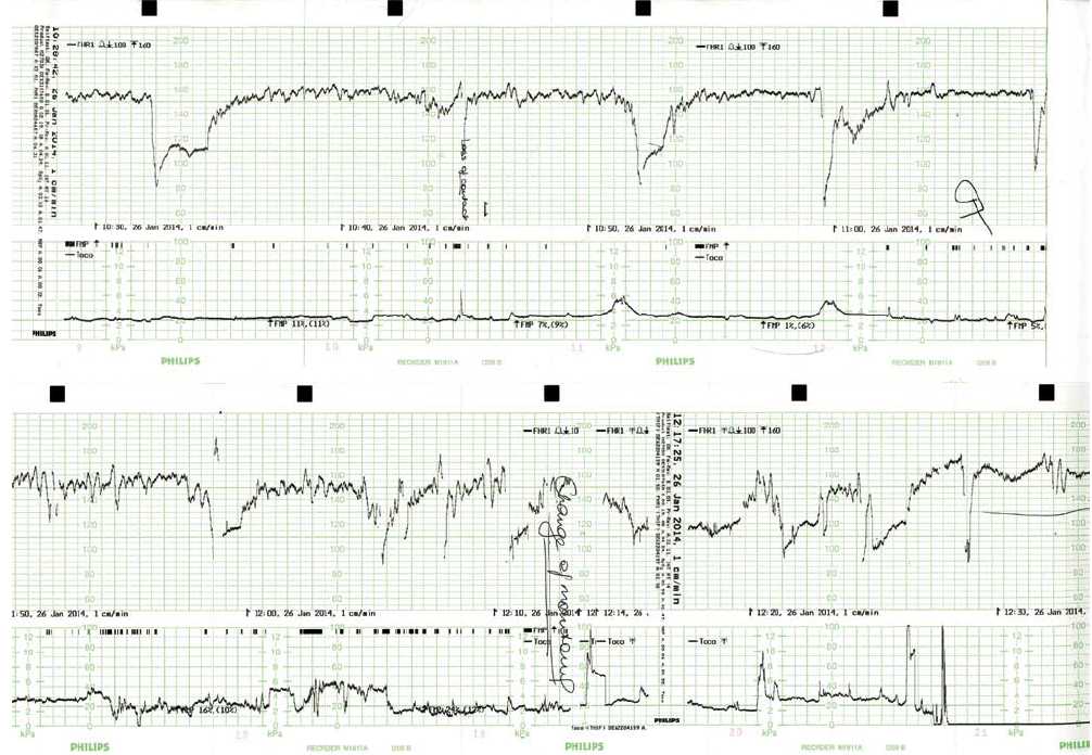 CTG for fetal surveillance