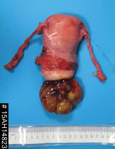 embryonal rhabdomyosarcoma specimen