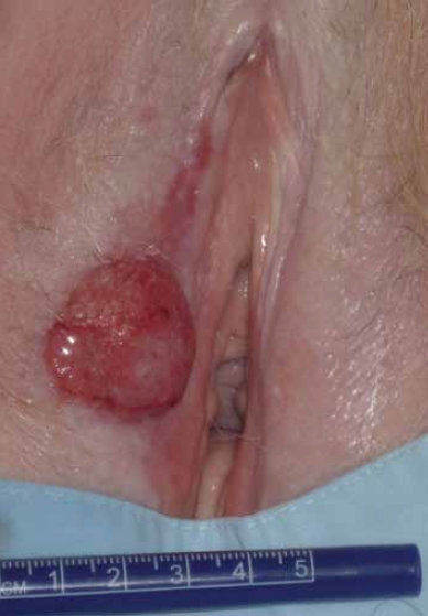 Vulvar vaginal cancers: carcinoma of the vulva