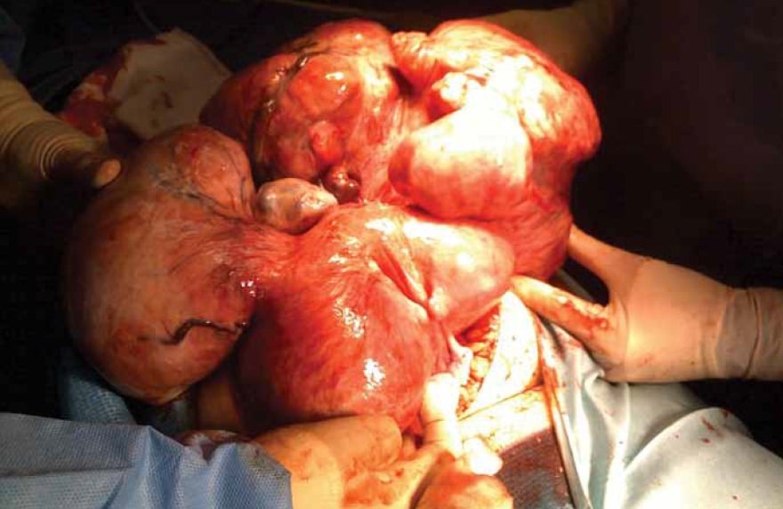 massive uterine fibroids at hysterectomy