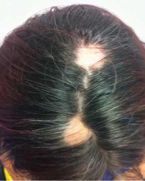 L-IUD caused hair loss