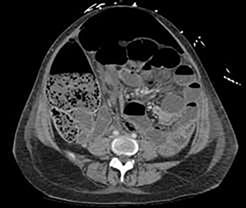 Ogilvie's syndrome