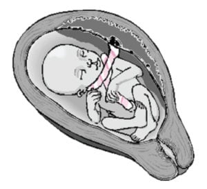 Type A – nuchal cord loop that encircles the neck in a freely sliding pattern.