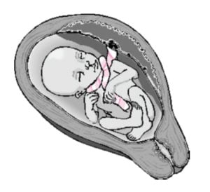 Type B – nuchal cord loop that encircles the neck in a locked pattern.