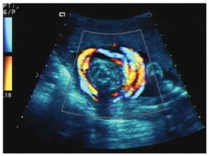Ultrasound image showing nuchal cord