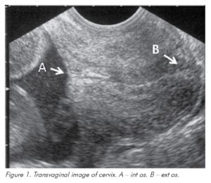 Q&A: Requesting cervical length scan at 20 weeks