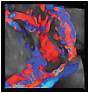 Figure 1b: 3D power Doppler: Newly formed blood vessels and lacunae.