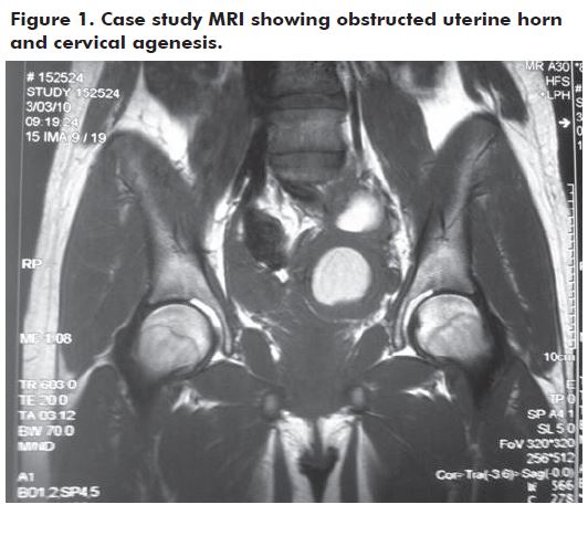 Figure 1. Case study MRI showing obstructed uterine horn and cervical agenesis.