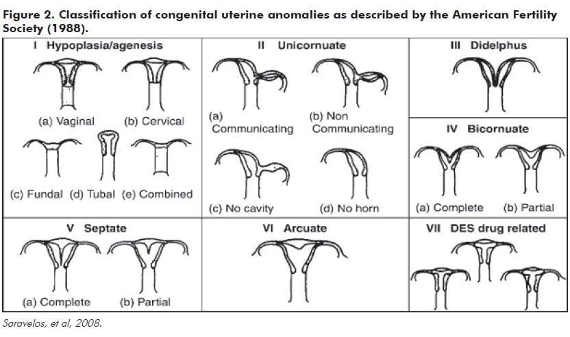Figure 2. Classification of congenital uterine anomalies as described by the American Fertility Society (1988).