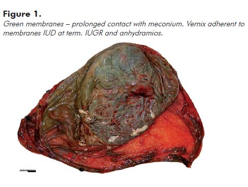 Figure 1. Green membranes – prolonged contact with meconium. Vernix adherent to membranes IUD at term. IUGR and anhydramios.