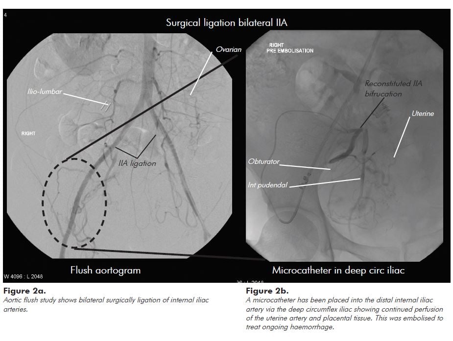 Figure 2a. Aortic flush study shows bilateral surgically ligation of internal iliac arteries. Figure 2b. A microcatheter has been placed into the distal internal iliac artery via the deep circumflex iliac showing continued perfusion of the uterine artery and placental tissue. This was embolised to treat ongoing haemorrhage.