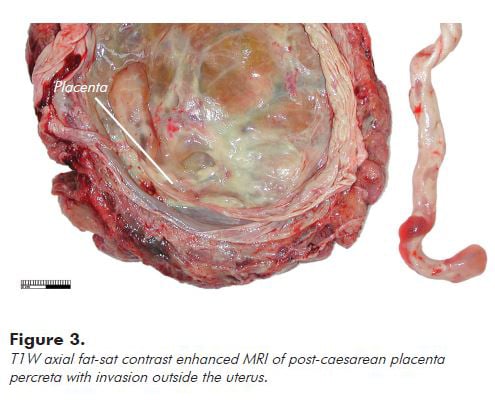 Figure 3. T1W axial fat-sat contrast enhanced MRI of post-caesarean placenta percreta with invasion outside the uterus.