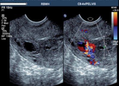 Gray scale ultrasound showing the serpiginous structures within the myometrium, which raised the concern for a uterine AVM.