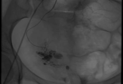 Angiography: Pre R) uterine artery embolisation. Note the serpiginous tangle of vessels.