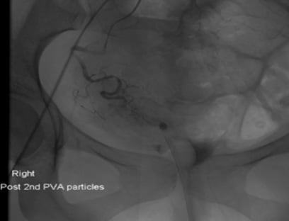 Angiography: Post R) uterine artery embolisation. 