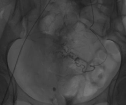 Pre L) uterine artery embolisation.