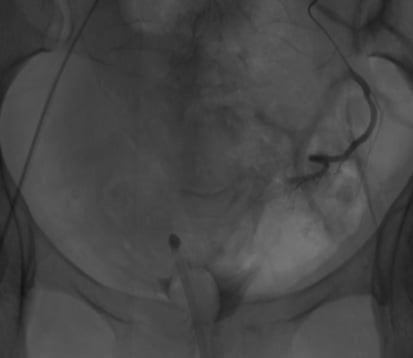 Post L) uterine artery embolisation.