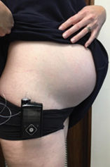 An insulin pump clipped on a waistband.