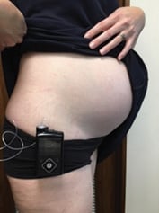 An insulin pump clipped on a waistband.
