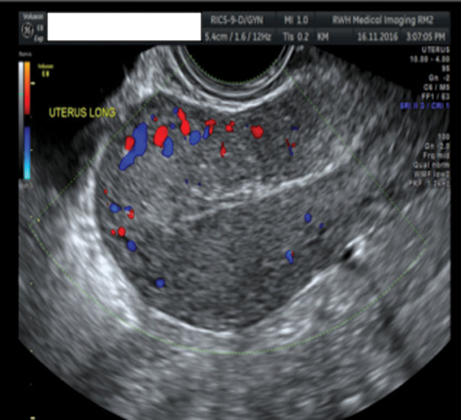 6/52 post-bilateral uterine artery embolisation.