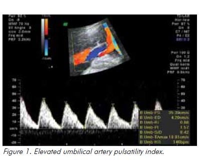 Figure 1. Elevated umbilical artery pulsatility index.
