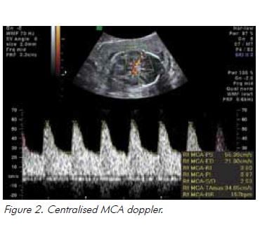 Figure 2. Centralised MCA doppler.