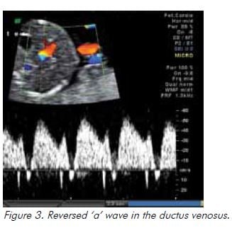 Figure 3. Reversed ‘a’ wave in the ductus venosus. 