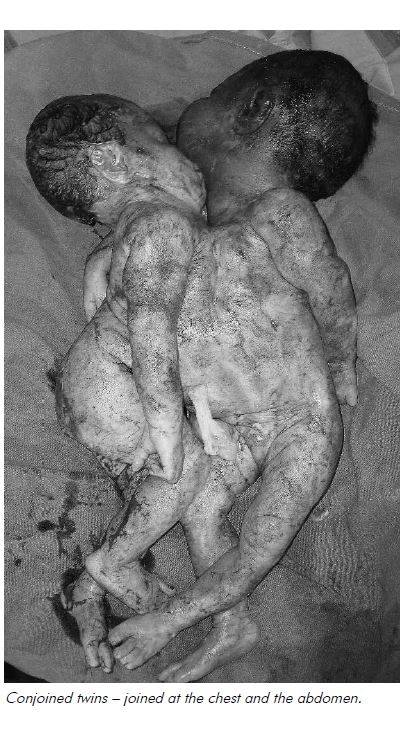 Conjoined twins – joined at the chest and the abdomen.