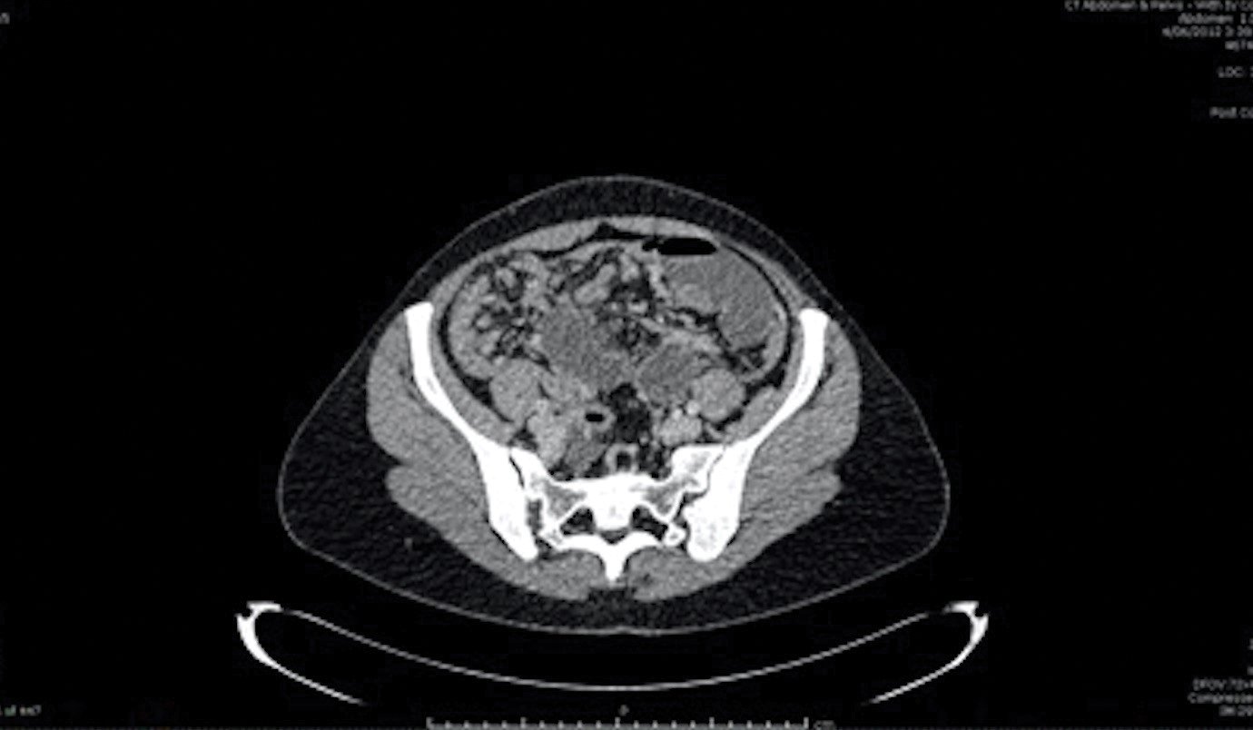 Figure 1. Small bowel obstruction. CT scan demonstrating small bowel obstruction with transition point and diffuse peritoneal disease.