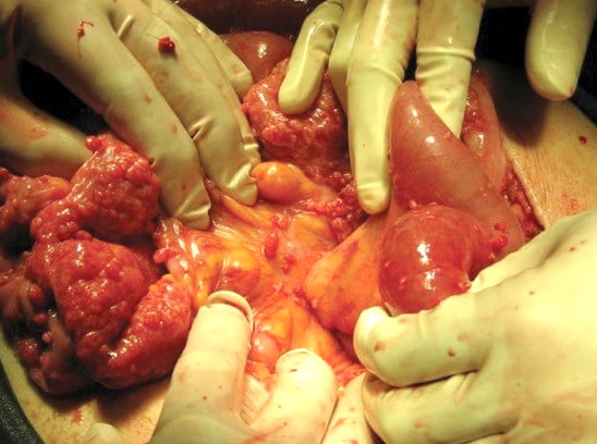 Figure 2. Disseminated leiomyosis peritoneii. Innumerable smooth muscle tumourlets can be seen scattered across peritoneal surfaces.